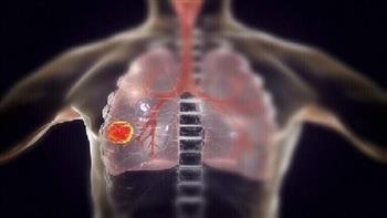 هذه أعراض الإصابة بسرطان الرئة لغير المدخنين