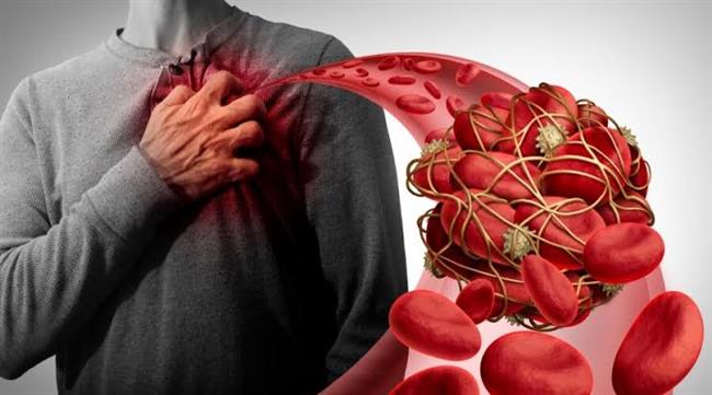 للوقاية من الاصابة بالجلطات .. اتبع الآتى