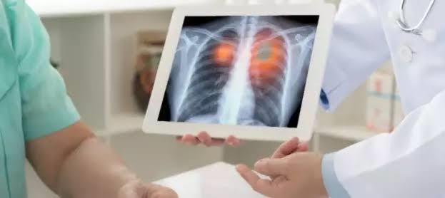 انتبه.. هذه أعراض سرطان الرئة