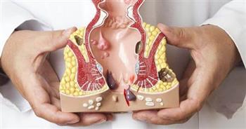 للوقاية من الاصابة بالبواسير .. تجنب الإمساك