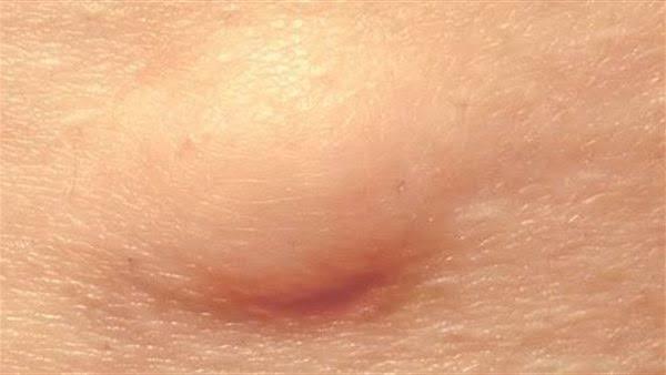 الفرق بين التكيس والورم