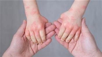 للأمهات.. نصائح لتهدئة قلقك وحماية أطفالك من فيروس HFMD