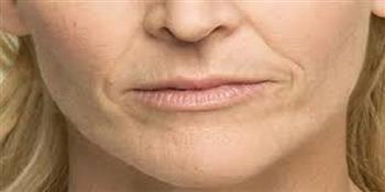 وداعًا لخطوط الابتسامة.. طرق طبيعية لتقليل التجاعيد حول الفم