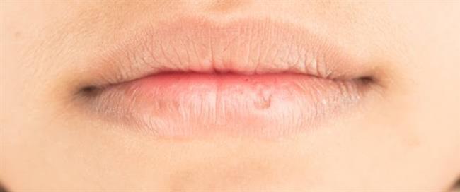 طرق بسيطة للتخلص من تشقق الشفاه ..في الخريف