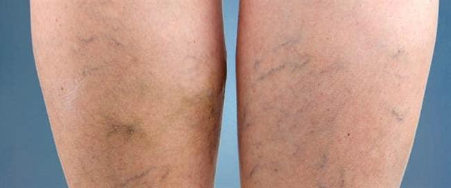 5 أسباب للإصابة بدوالى الساقين