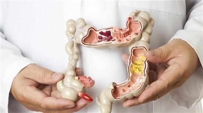 مرحلة التحسن في التهاب القولون التقرحي..هل تنبأ بنهاية الالتهاب؟ 