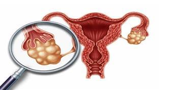 "تكيس المبايض...واجهيه بالطعام