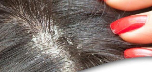 هذا هو الفرق بين قشرة الشعر العادية وإلتهاب الجلد الدهني!