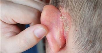 تعرف على أعراض صدفية الأذن