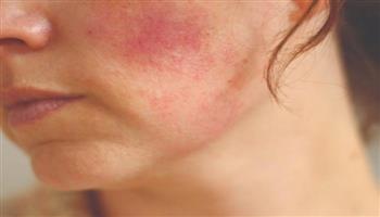 قبل العلاج .. تعرف على تأثير الشمس على الجلد