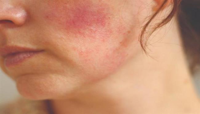 قبل العلاج .. تعرف على تأثير الشمس على الجلد