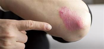 انتبه ..لأعراض الإكزيما العصبية