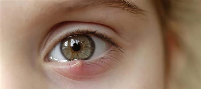 أسباب تكون الكيس الدهني في العين