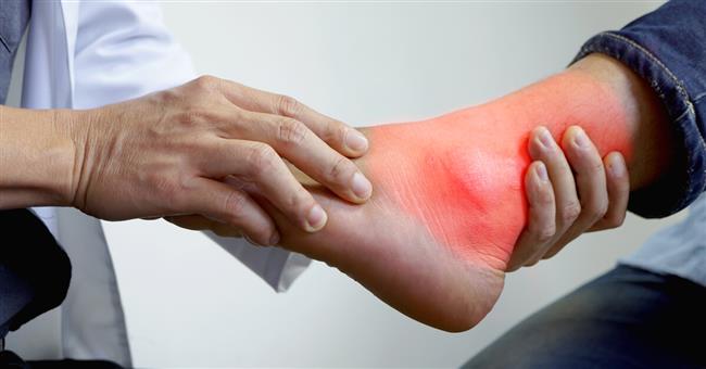 أعراض نوبة النقرس الحادة