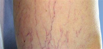 احمي نفسك من الإصابة بدوالي الساقين