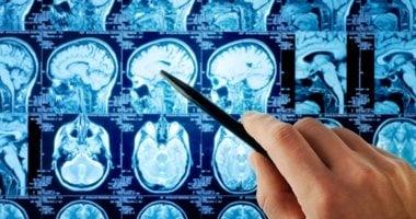 5 مؤشرات قد تشير إلى مشكلة في الدماغ
