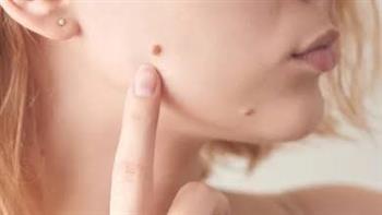 الوحمات ليست مجرد علامة جمال..ولكن!