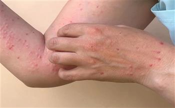 نيجيريا تسجل 389 إصابة بـ "جدري القرود" و6 وفيات خلال أكتوبر الماضي