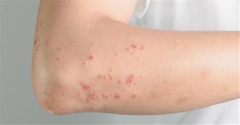 أسباب وأعراض الأرتيكاريا