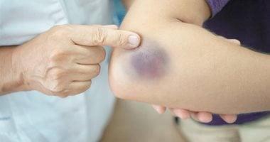 لماذا تتعرض لحدوث الكدمات أو النزيف؟