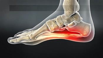 ماذا تعرف على التهاب لفافة القدم الاخمصية