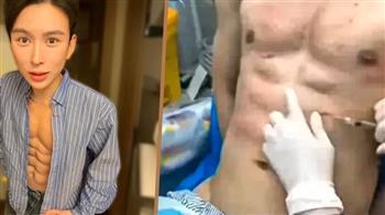 صيني ينفق نصف مليون دولار لحقن عضلات بطن صناعية