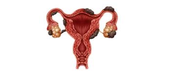 هذه هي أعراض بطانة الرحم المهاجرة