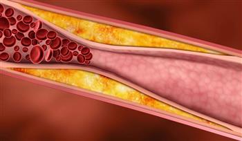 تلك هي أعراض تصلب الشرايين