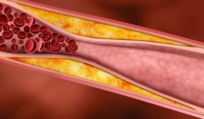 تلك هي أعراض تصلب الشرايين