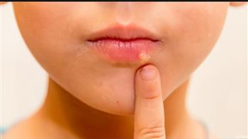 أعراض قرح البرد لدى الأطفال