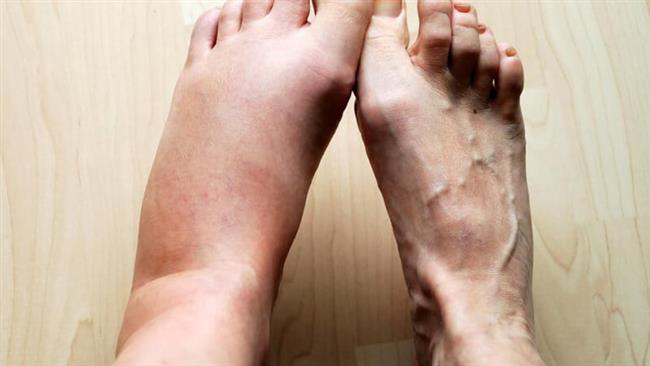 القدم السكرى .. وعلامات خطر يجب الانتباه لها