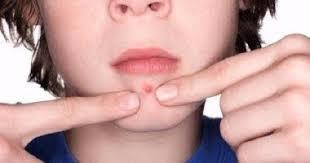 انتبه الدمامل تسبب هذه الأعراض