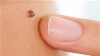 أسباب ظهور الزوائد الجلدية وطرق الوقاية