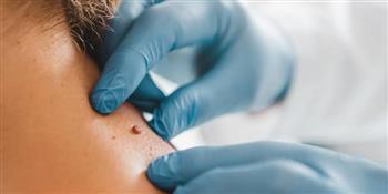 علاجات طبيعية للتخلص من الزوائد الجلدية