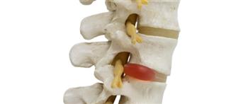 أعراض الانزلاق الغضروفي