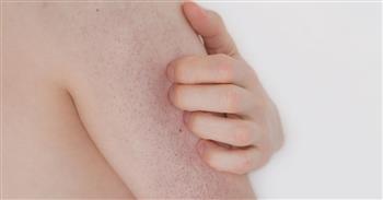 طرق طبيعية للتخلص من "جلد الوزة"