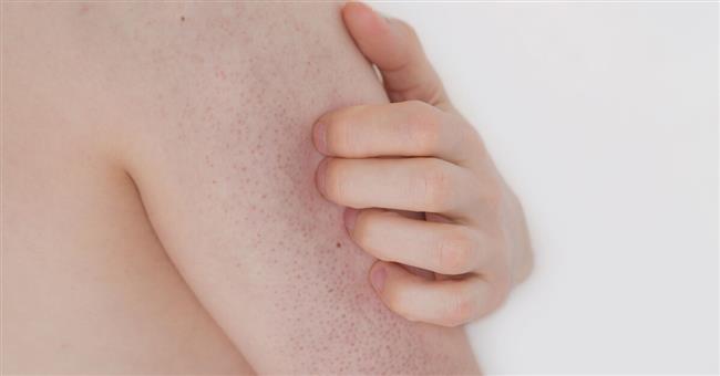 طرق طبيعية للتخلص من "جلد الوزة"