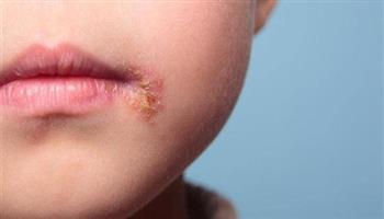 نصائح طبية للتعامل مع الهربس