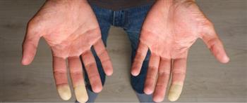 نصائح للوقاية من نوبات "رينود" 