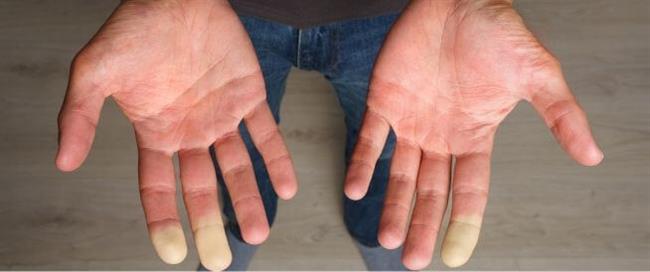 نصائح للوقاية من نوبات "رينود" 