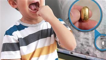 طفل يبتلع 10 جرامات ذهب ووالدته تنتظر "الكنز" في المرحاض