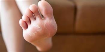 تعرفي على أسباب تقشر أطراف الأصابع وأفضل طرق العلاج