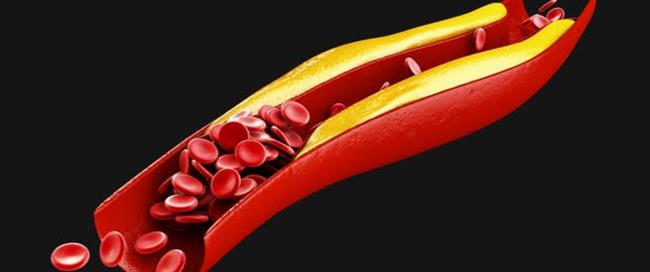 هكذا يكون تأثير إرتفاع الكوليسترول على الجسم