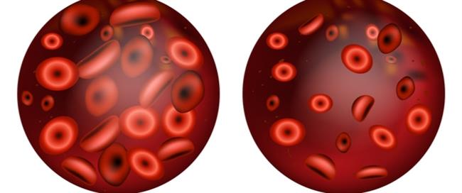 فقر الدم..أحد أسباب الإصابة بضيق التنفس