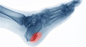 5 طرق للتعامل مع ألم "مسمار الكعب"