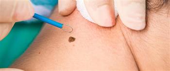 كيف تفرق بين الشامة العادية وسرطان الميلانوما؟