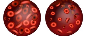 فقر الدم..أحد أسباب الإصابة بضيق التنفس