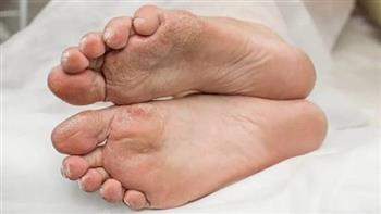 علامات تدل على إصابتك بالقدم السكري