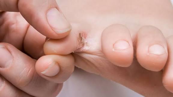 احذر ..فطريات القدم في الشتاء