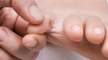 احذر ..فطريات القدم في الشتاء